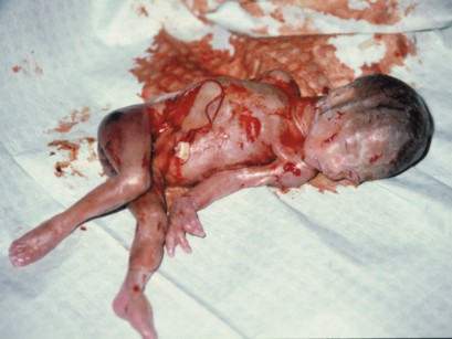 Abtreibung 22. Woche